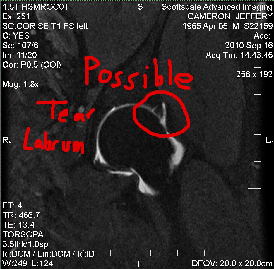 mri-showing-possible-tear-in-labrum